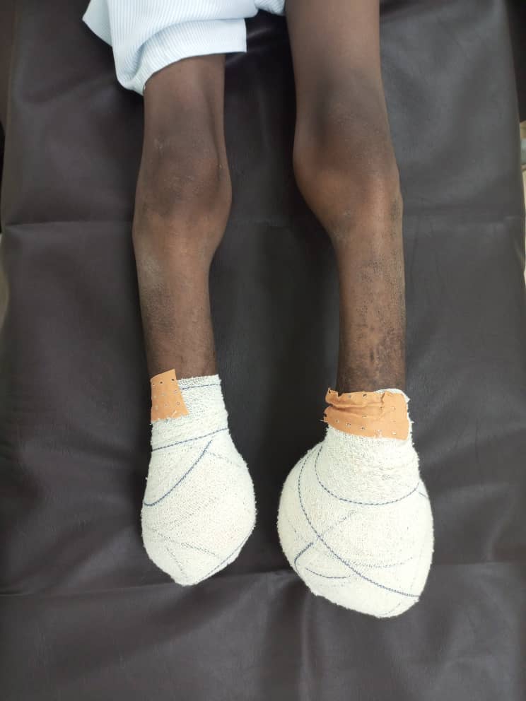 Privé : KOUADIO Yao 11 ans, amputé des 2 jambes à son arrivé le 25 avril 2024